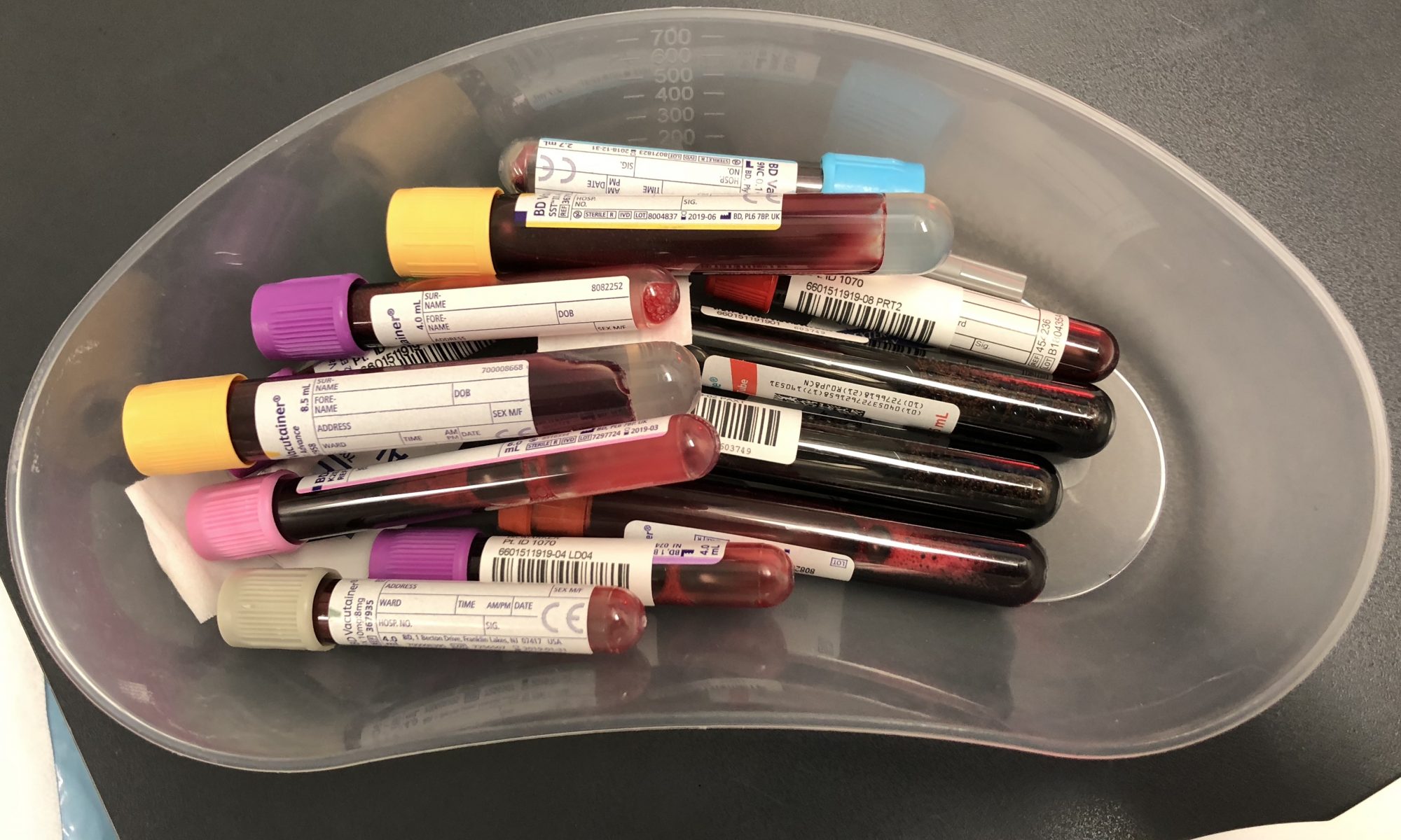 Louise Decelis's Blood used for Immunotherapy Trial